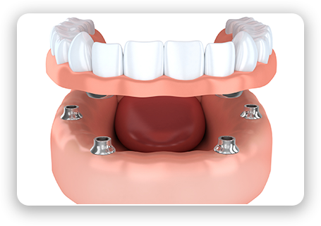 graphic of all-on-four dental implants and overdentures