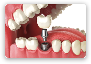 Ask about our dental implants in Ewa Beach