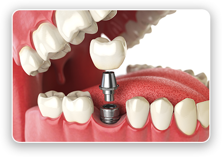 graphic of single dental implant post, attachment, and restoration being placed in back of mouth