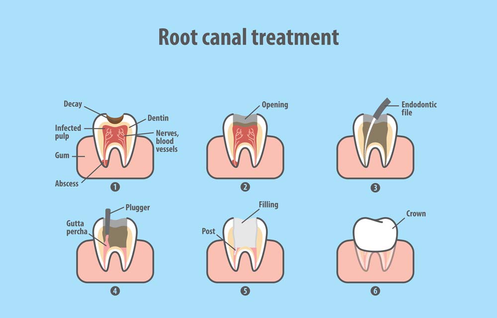 root canal