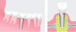Artistic rendering of a dental implant showing the implant fused in the bone on the left and the implant topped with a crown on the right