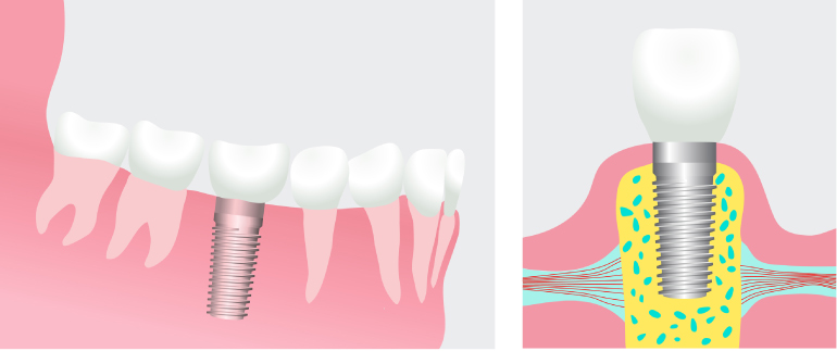 Artistic rendering of a dental implant showing the implant fused in the bone on the left and the implant topped with a crown on the right