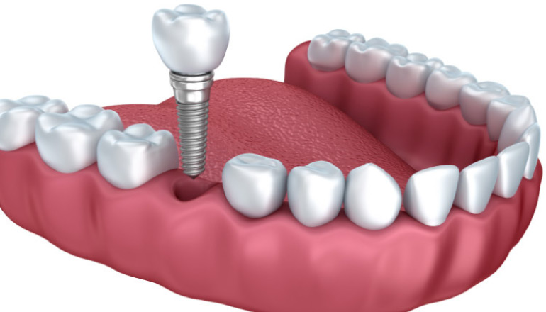 dental implants model